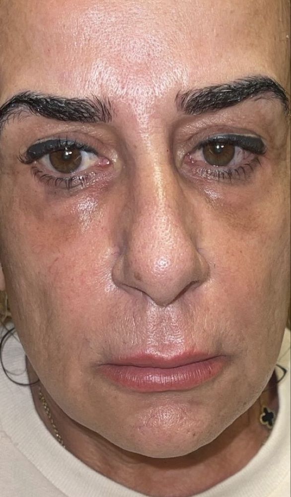 אותה לקוחה, מבט מלפנים, אחרי הטיפול